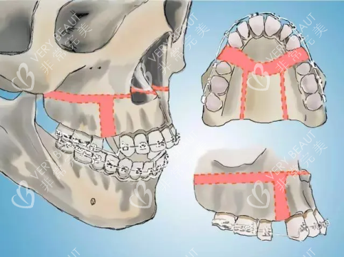 正颌手术示意图
