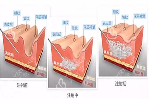 玻尿酸注射皮肤内在过程示意图