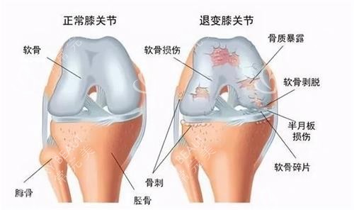 正常膝关节和膝盖关节炎的膝盖对比