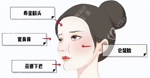 维密金雕哪家整形医院都有?上海时光整形/成都艾米丽医疗美容/青岛华颜美整形都能做维密金雕修复馒化脸