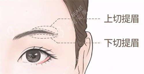 提眉手术不同切口