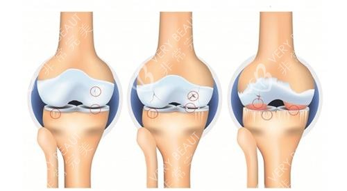 膝盖关节炎的严峻程度