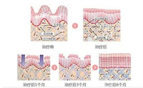 热拉提的治疗成效