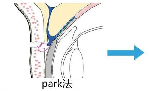 Park法双眼皮