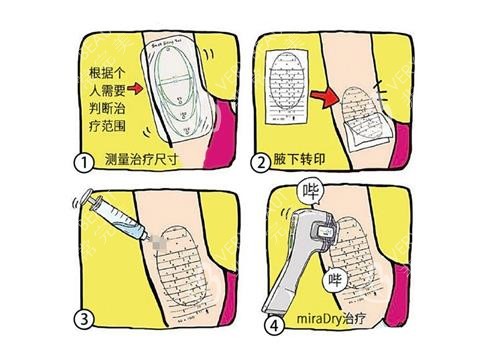 miradry微波治疗的过程图