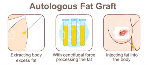 自体脂肪隆胸手术过程