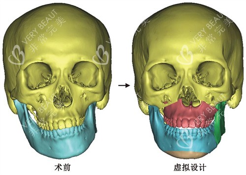 脸部歪斜术前术后动画图