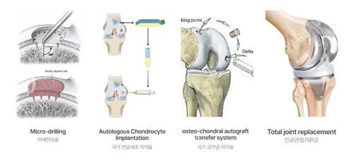 韩国JS整形干细胞治疗过程