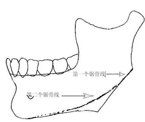 下颌骨截骨出现二次角示意图