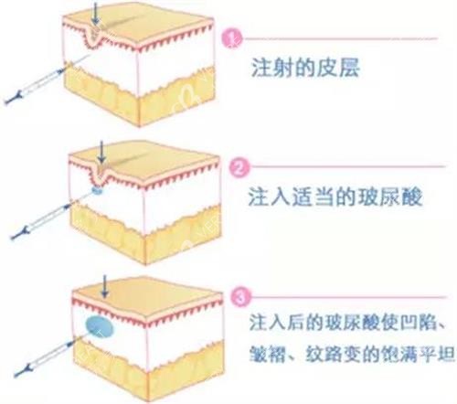 玻尿酸注射示意图