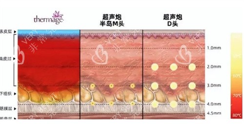 超声炮治疗深度对比