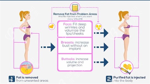 自体脂肪用来丰胸丰臀