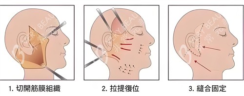 面部除皱拉皮法演示动画图