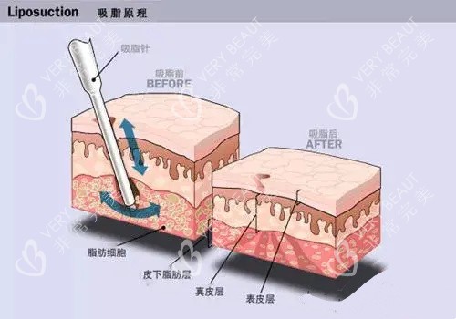 水动力吸脂手术原理动画图