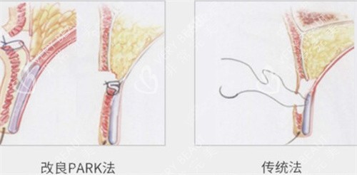 park双眼皮和传统对比