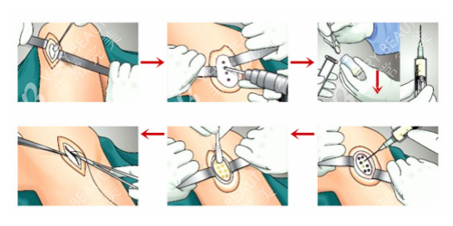 韩国js整形外科膝关节治疗卡通过程示意图