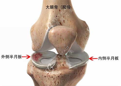 外侧半月板和内侧半月板