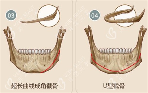 下颌角截骨手术改善展示图