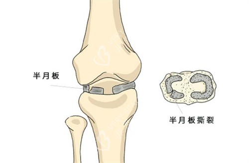 半月板撕裂展示图照片