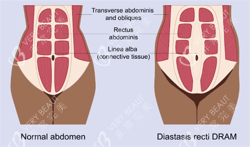 腹壁成形改善肌肉