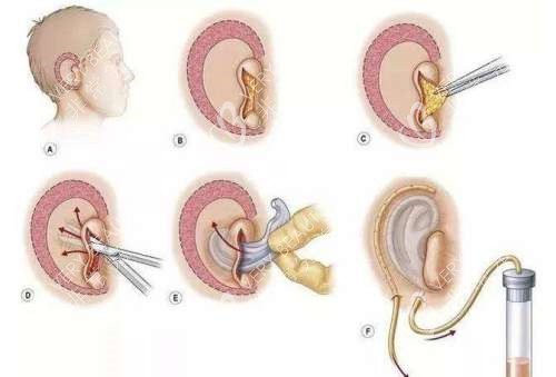 耳再造手术演示动画图