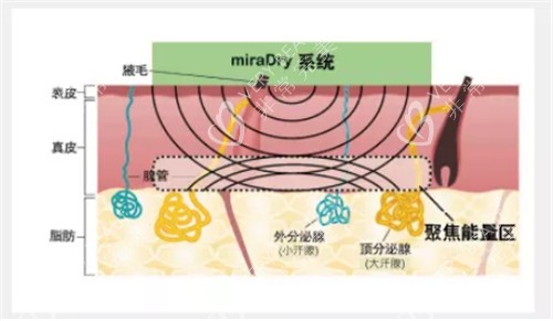 miradry微波去腋臭原理图示