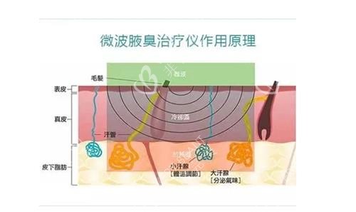 miradry微波治疗原理