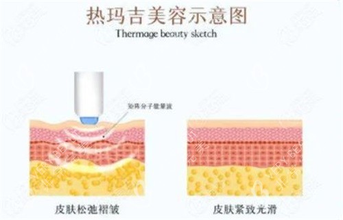 热玛吉美容示意图