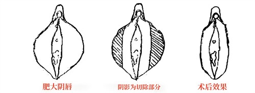 小阴唇肥大直接切除法演示动画图