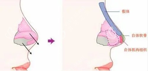 假体肋骨复合型隆鼻示意图