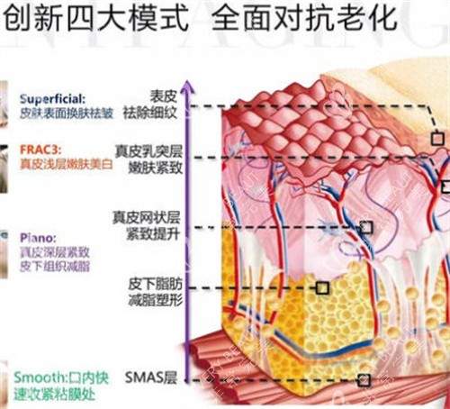 fotona4d欧洲之星不同模式对应层次