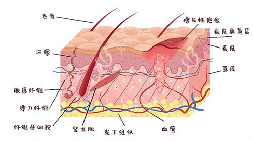 增生疤痕是怎么形成的