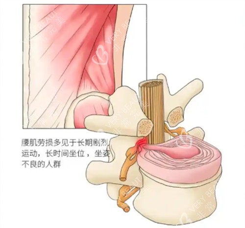 腰肌劳损骨头的变化