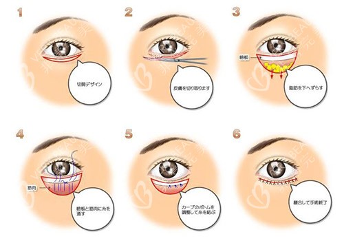 眼睑下至手术方法