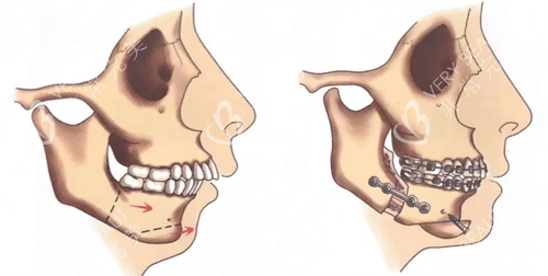 正颌手术前后图