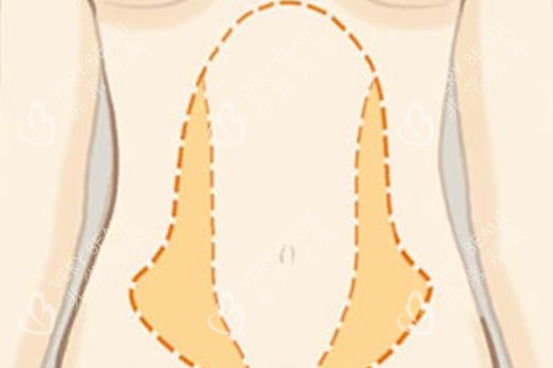 腰腹吸脂位置示意图