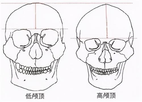 高颅顶和低颅顶的区别