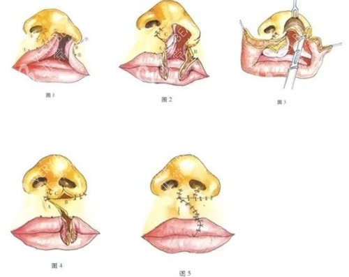 兔唇修复手术过程图解