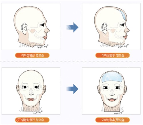 韩国雕刻整形医院颅顶填充手术动画图