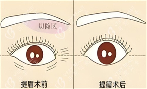 提眉手术前后对比