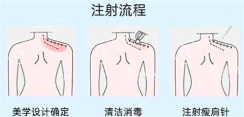 瘦肩注射点位图