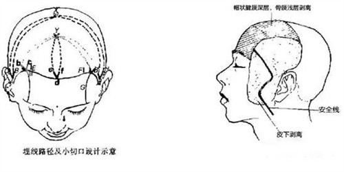 面部小切口悬吊术