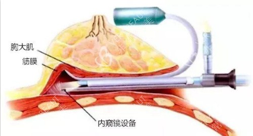 内窥镜隆胸示意图