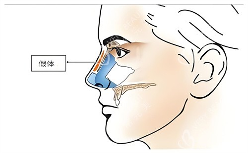 硅胶假体隆鼻手术