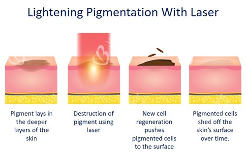 激光祛斑如何改善皮肤斑点
