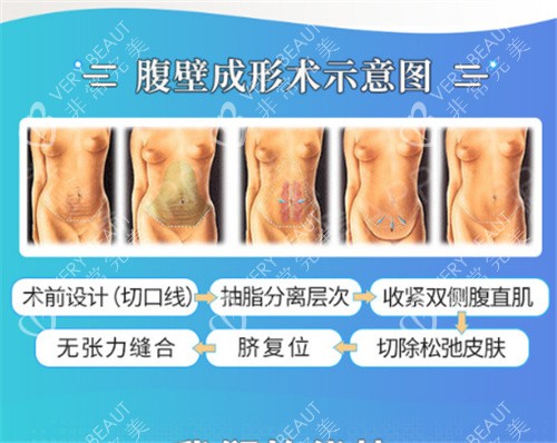 腹壁成形术示意图