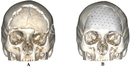 颅骨修补前后对比