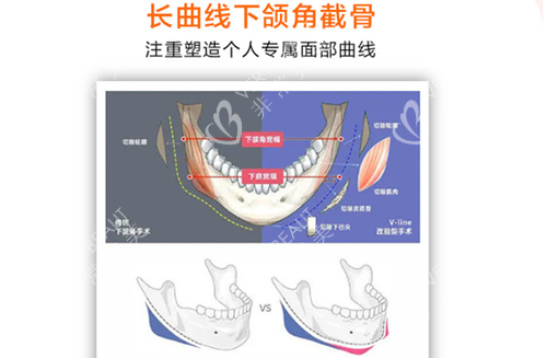 杭州高俊明下颌角截骨