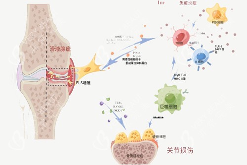 增生性关节炎示意图