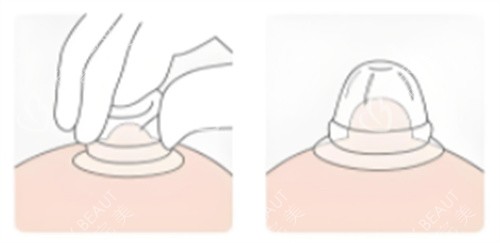 乳头内陷矫正器使用